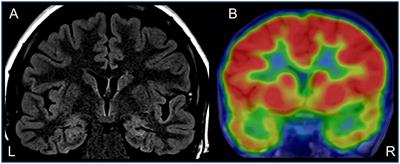 Interaction of Temporal Lobe Epilepsy and Posttraumatic Stress Disorder: Network Analysis of a Single Case